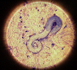 Strongyloides stercoralis